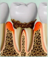 中度の歯周病画像