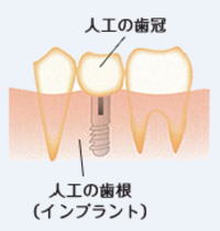 人工の歯根