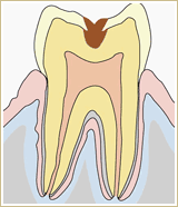 むし歯治療画像2