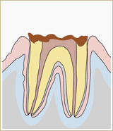 むし歯治療画像4
